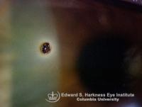 Corneal metallic foreign body and residual rust ring after its removal.